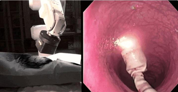 还记得被胃镜, 结肠镜支配的恐惧吗, 这个胶囊大小的机器人来救你了