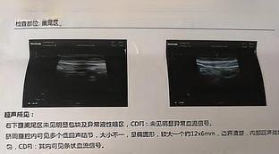 西甲硅油乳剂肠镜要一次喝完么