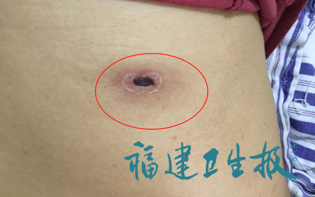 进入高发期！男子被咬后，紧急送入ICU抢救