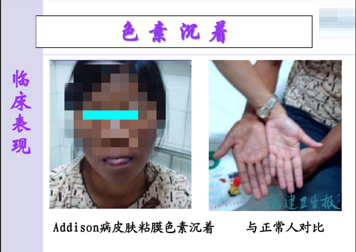 福州女子全身莫名变黑！拖了6年差点出大事！医生：警惕这些信号