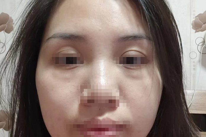 水光后肉芽肿图片