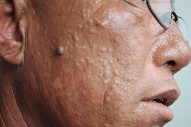 老年性皮脂腺增生图