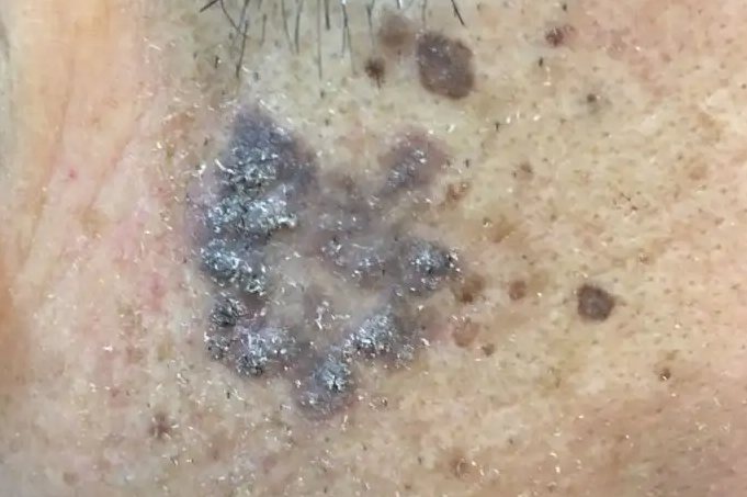 老年斑癌变初期