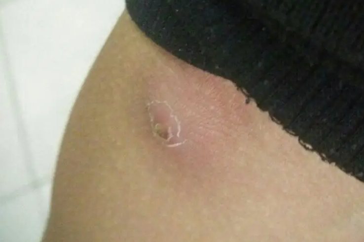 疖子痊愈后疤痕