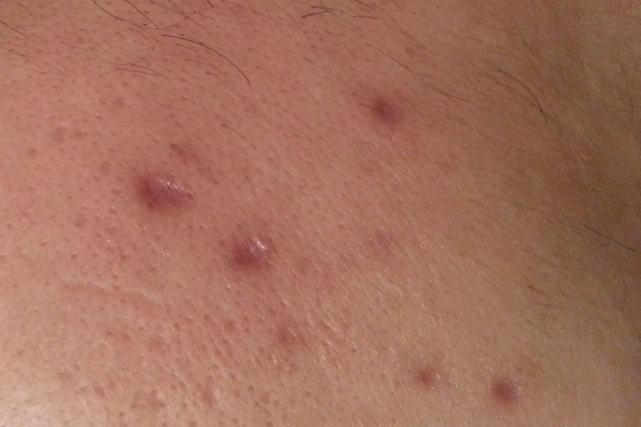 水痘留下的疤痕