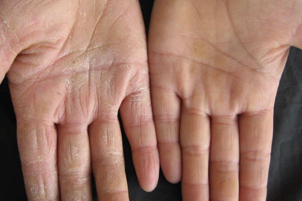 角质增厚型手癣