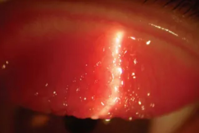 结膜炎长水泡图