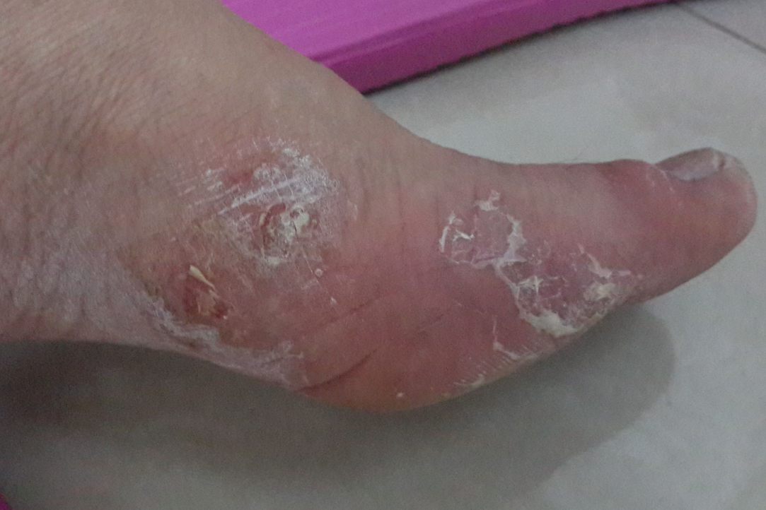 足癣