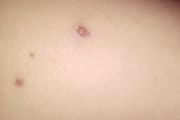 水痘快愈合的图片