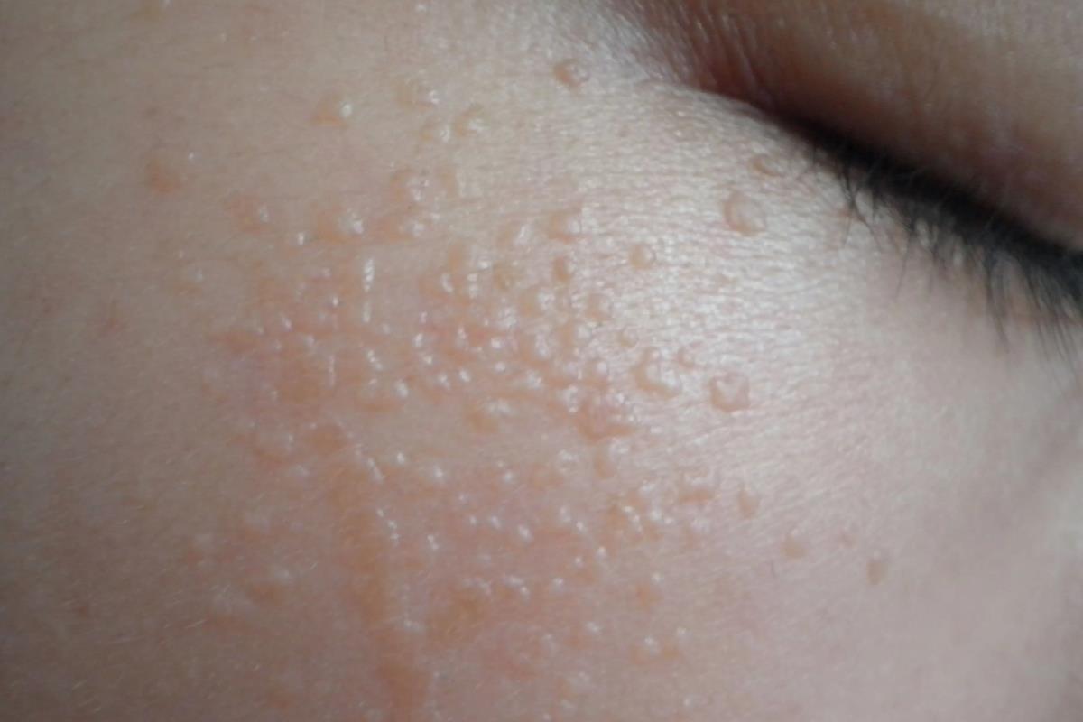 hpv脸上扁平疣图片