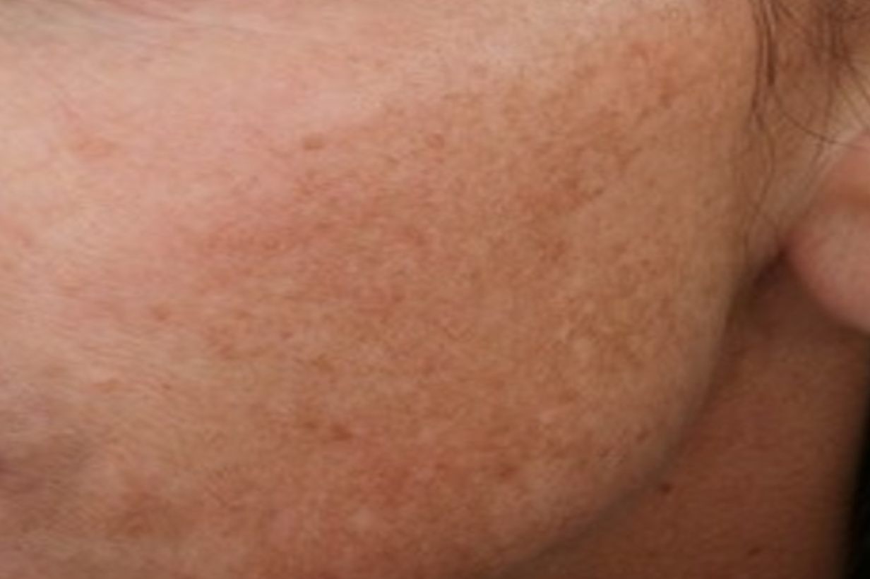 激光祛斑反黑图片