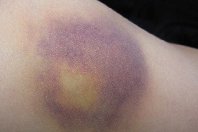 外伤所致的皮肤瘀斑