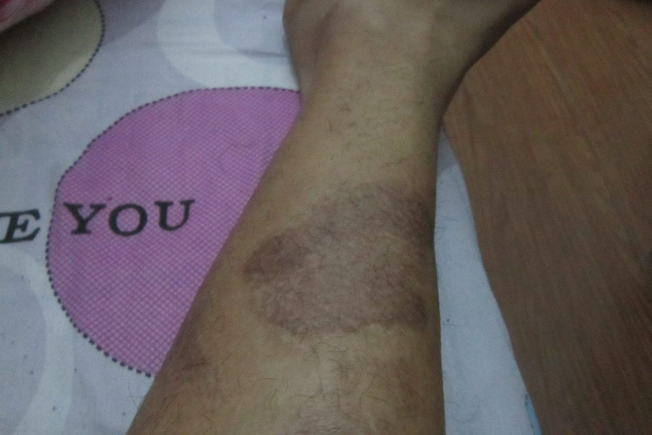 银屑病留下的黑斑