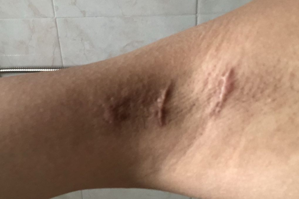 腋下紫色瘢痕图片