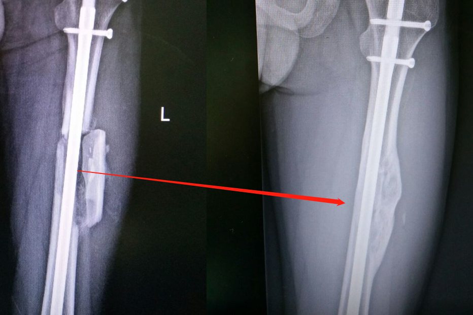 骨折术后100天骨痂