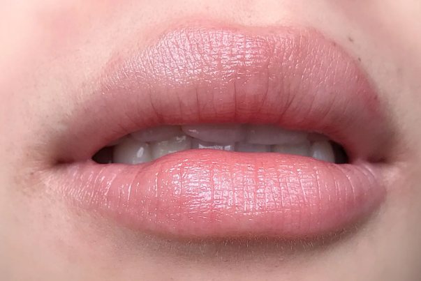 整容嘴唇变薄效果图