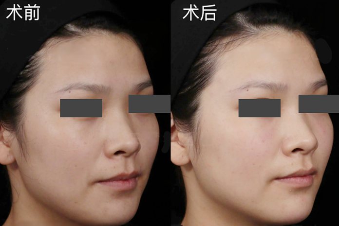 假体眉弓填充前后照片