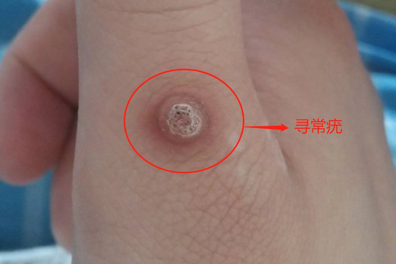 寻常疣早期图片