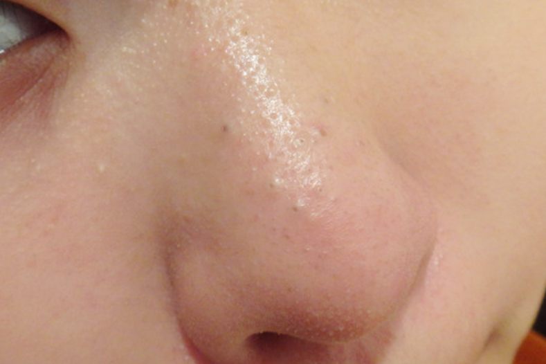 鼻子两侧长脂肪粒