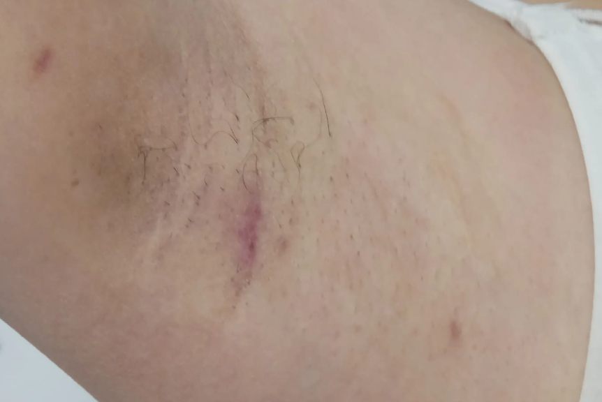 腋臭手术恢复期照片