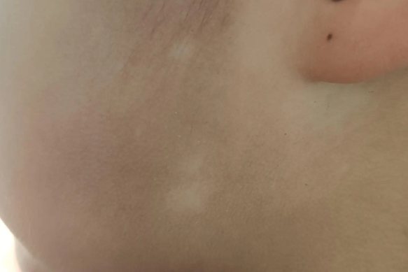 维生素缺乏引起的白斑