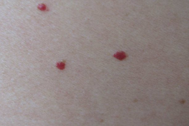 红痣