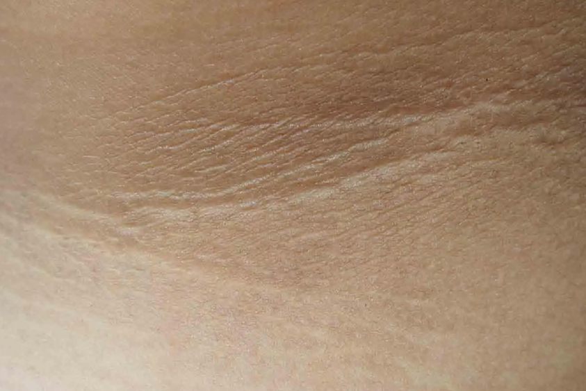 大腿根黑棘皮症