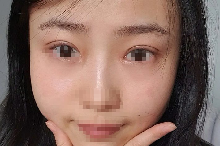 全切双眼皮半年效果图