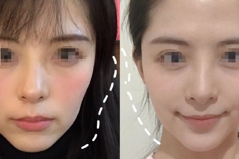 面部填充前后对比