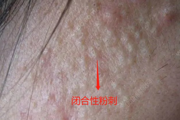 闭合性粉刺