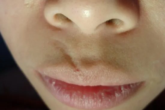 组织缺损性凹陷疤痕