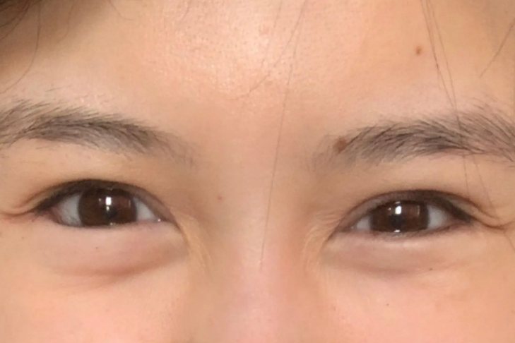 单纯眼轮匝肌肥厚型