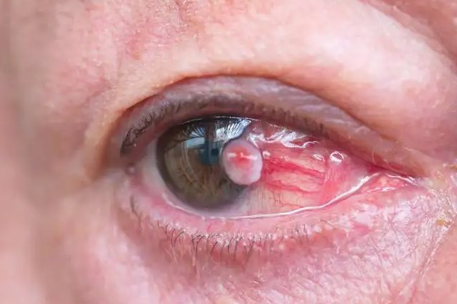 脉络膜恶性黑色素瘤