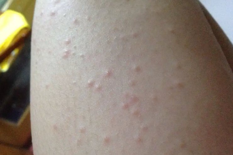 人感染兔子螨虫的症状