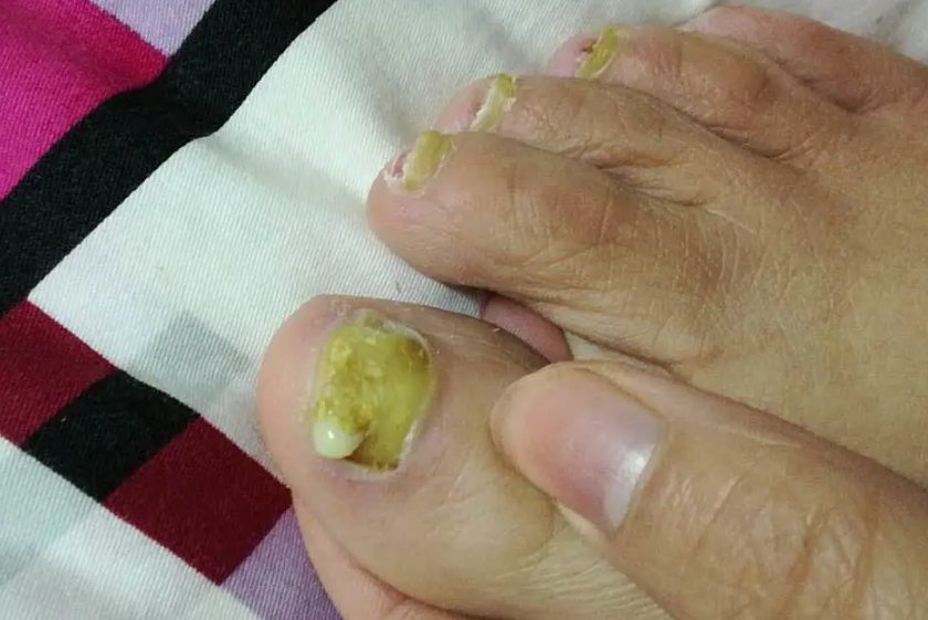 灰指甲里面出脓水