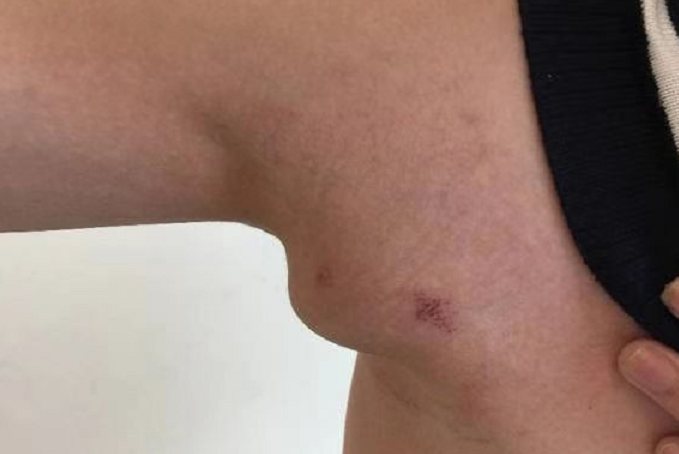 良性腋下淋巴结