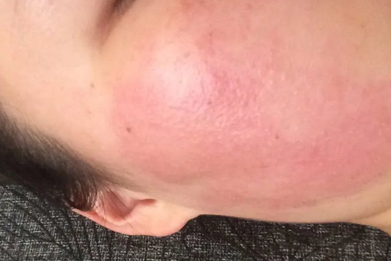 芒果过敏导致皮炎