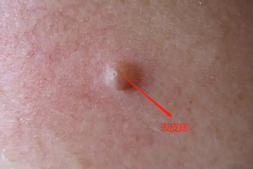 表皮痣图片