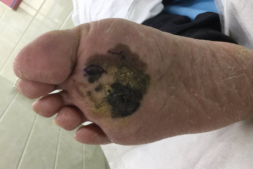 恶性雀斑样黑素瘤