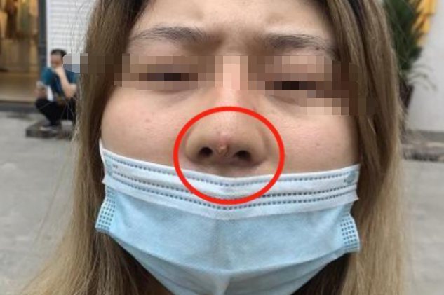 隆鼻后假体外露图片