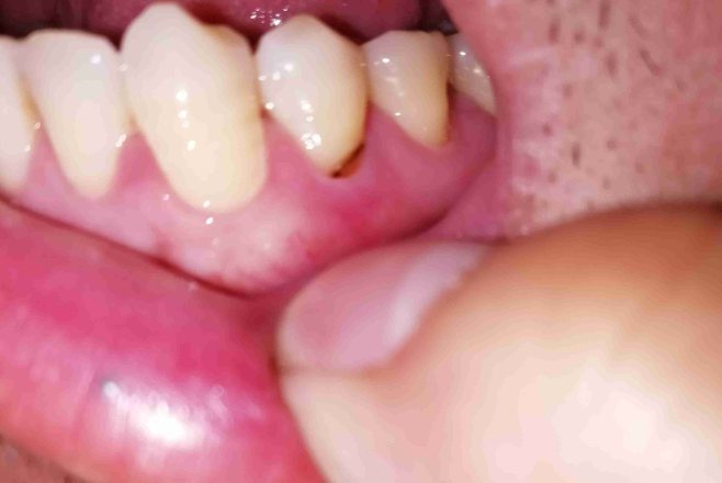 外伤导致牙龈裂伤