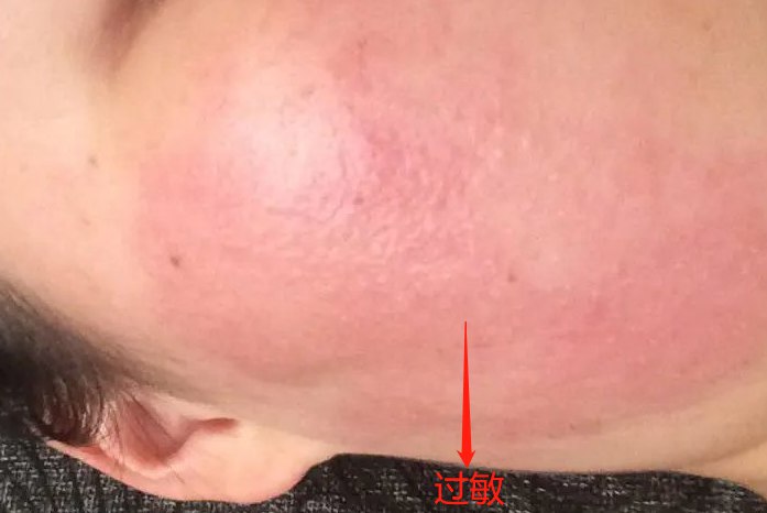 脸上过敏发红图片