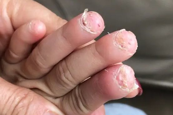 没有指甲的手指