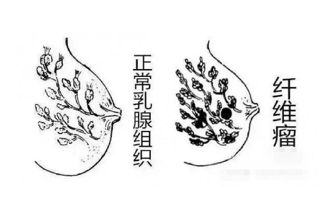 乳腺纤维瘤