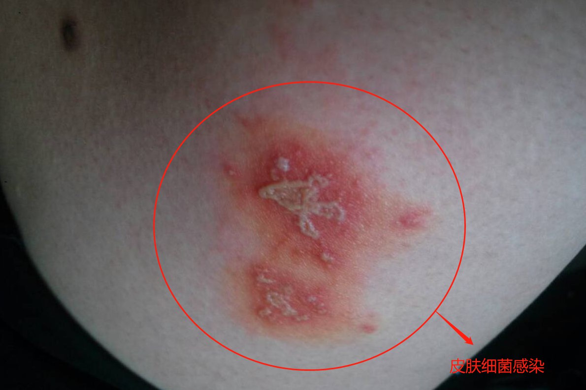 大腿皮肤细菌感染