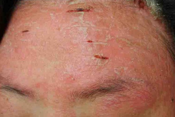 面部牛皮癣