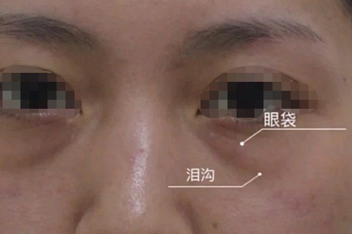 眼袋泪沟图片