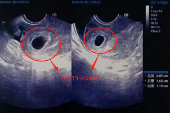 怀孕1个月b超图