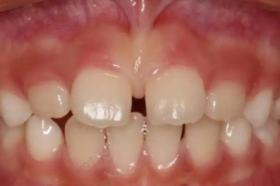 唇系带过低门牙缝隙大