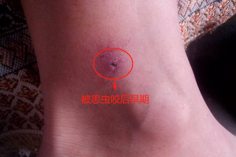 被恙虫咬后早期图片